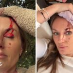 Mum ‘lucky to be alive’ after being hit by tree trunk in Storm Boelo
